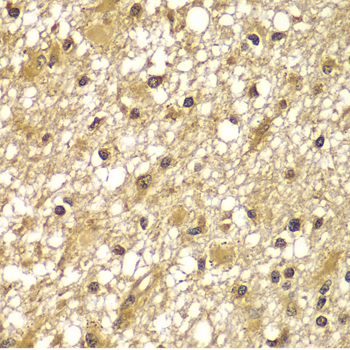 PIK3R3 / p85 Gamma Antibody - Immunohistochemistry of paraffin-embedded human brain cancer tissue.