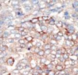 PIK3R4 Antibody - Formalin-fixed and paraffin-embedded human cancer tissue reacted with the primary antibody, which was peroxidase-conjugated to the secondary antibody, followed by DAB staining. This data demonstrates the use of this antibody for immunohistochemistry; clinical relevance has not been evaluated. BC = breast carcinoma; HC = hepatocarcinoma.