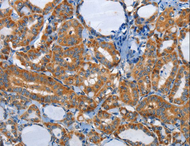 PIK3R4 Antibody - Immunohistochemistry of paraffin-embedded Human thyroid cancer using PIK3R4 Polyclonal Antibody at dilution of 1:85.