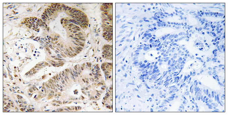 PIK3R5 Antibody - Immunohistochemistry analysis of paraffin-embedded human colon carcinoma tissue, using PIK3R5 Antibody. The picture on the right is blocked with the synthesized peptide.