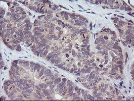 PIK3R5 Antibody - IHC of paraffin-embedded Adenocarcinoma of Human ovary tissue using anti-PIK3R5 mouse monoclonal antibody.