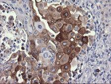 PIK3R5 Antibody - IHC of paraffin-embedded Carcinoma of Human lung tissue using anti-PIK3R5 mouse monoclonal antibody.