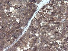 PIK3R5 Antibody - IHC of paraffin-embedded Adenocarcinoma of Human ovary tissue using anti-PIK3R5 mouse monoclonal antibody. (Heat-induced epitope retrieval by 10mM citric buffer, pH6.0, 120°C for 3min).