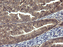 PIK3R5 Antibody - IHC of paraffin-embedded Adenocarcinoma of Human endometrium tissue using anti-PIK3R5 mouse monoclonal antibody. (Heat-induced epitope retrieval by 10mM citric buffer, pH6.0, 120°C for 3min).