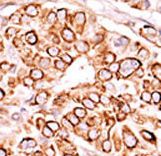 PIKFYVE / PIP5K Antibody - Formalin-fixed and paraffin-embedded human cancer tissue reacted with the primary antibody, which was peroxidase-conjugated to the secondary antibody, followed by AEC staining. This data demonstrates the use of this antibody for immunohistochemistry; clinical relevance has not been evaluated. BC = breast carcinoma; HC = hepatocarcinoma.