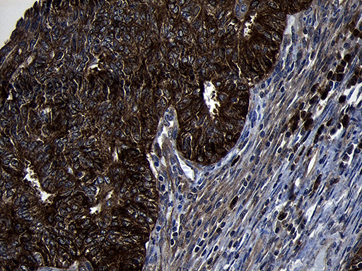 PIKFYVE / PIP5K Antibody - Immunohistochemical staining of paraffin-embedded Adenocarcinoma of Human endometrium tissue using anti-PIKFYVE mouse monoclonal antibody. (Heat-induced epitope retrieval by 1mM EDTA in 10mM Tris buffer. (pH8.5) at 120°C for 3 min. (1:2000)