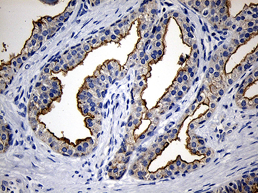 PIKFYVE / PIP5K Antibody - Immunohistochemical staining of paraffin-embedded Carcinoma of Human prostate tissue using anti-PIKFYVE mouse monoclonal antibody. (Heat-induced epitope retrieval by 1mM EDTA in 10mM Tris buffer. (pH8.5) at 120°C for 3 min. (1:150)