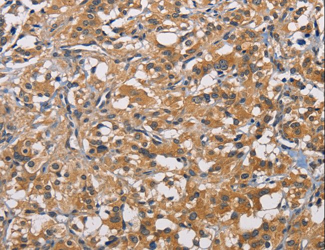 PIKFYVE / PIP5K Antibody - Immunohistochemistry of paraffin-embedded Human gastric cancer using PIKFYV Polyclonal Antibody at dilution of 1:50.