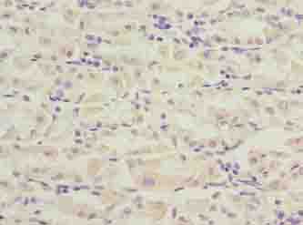 PILRB Antibody - Immunohistochemistry of paraffin-embedded human gastric cancer using antibody at dilution of 1:100.