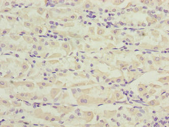 PILRB Antibody - Immunohistochemistry of paraffin-embedded human gastric cancer using PILRB Antibody at dilution of 1:100