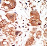 PIM1 / Pim-1 Antibody - Formalin-fixed and paraffin-embedded human cancer tissue reacted with the primary antibody, which was peroxidase-conjugated to the secondary antibody, followed by DAB staining. This data demonstrates the use of this antibody for immunohistochemistry; clinical relevance has not been evaluated. BC = breast carcinoma; HC = hepatocarcinoma.