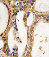 PIM1 / Pim-1 Antibody - Formalin-fixed and paraffin-embedded human prostate carcinoma tissue reacted with PIM1 antibody, which was peroxidase-conjugated to the secondary antibody, followed by DAB staining. This data demonstrates the use of this antibody for immunohistochemistry; clinical relevance has not been evaluated.