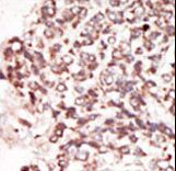 PIM2 / Pim-2 Antibody - Formalin-fixed and paraffin-embedded human cancer tissue reacted with the primary antibody, which was peroxidase-conjugated to the secondary antibody, followed by DAB staining. This data demonstrates the use of this antibody for immunohistochemistry; clinical relevance has not been evaluated. BC = breast carcinoma; HC = hepatocarcinoma.