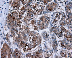 PIM2 / Pim-2 Antibody - IHC of paraffin-embedded Carcinoma of liver tissue using anti- mouse monoclonal antibody. (Dilution 1:50).