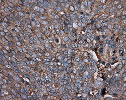 PIM2 / Pim-2 Antibody - Immunohistochemical staining of paraffin-embedded Adenocarcinoma of ovary tissue using anti- mouse monoclonal antibody. (Dilution 1:50).