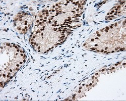 PIM2 / Pim-2 Antibody - Immunohistochemical staining of paraffin-embedded prostate tissue using anti- mouse monoclonal antibody. (Dilution 1:50).