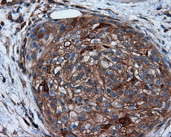 PIM2 / Pim-2 Antibody - IHC of paraffin-embedded Carcinoma of pancreas tissue using anti- mouse monoclonal antibody. (Dilution 1:50).
