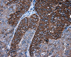 PIM2 / Pim-2 Antibody - IHC of paraffin-embedded Adenocarcinoma of endometrium tissue using anti- mouse monoclonal antibody. (Dilution 1:50).
