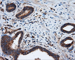 PIM2 / Pim-2 Antibody - IHC of paraffin-embedded Carcinoma of prostate tissue using anti- mouse monoclonal antibody. (Dilution 1:50).