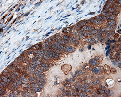PIM2 / Pim-2 Antibody - IHC of paraffin-embedded Adenocarcinoma of ovary tissue using anti- mouse monoclonal antibody. (Dilution 1:50).