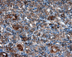 PIM2 / Pim-2 Antibody - IHC of paraffin-embedded Carcinoma of thyroid tissue using anti- mouse monoclonal antibody. (Dilution 1:50).