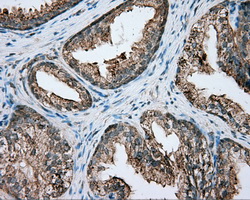 PIM2 / Pim-2 Antibody - Immunohistochemical staining of paraffin-embedded prostate tissue using anti-PIM2 mouse monoclonal antibody. (Dilution 1:50).