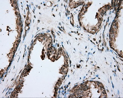 PIM2 / Pim-2 Antibody - Immunohistochemical staining of paraffin-embedded Carcinoma of prostate tissue using anti-PIM2 mouse monoclonal antibody. (Dilution 1:50).