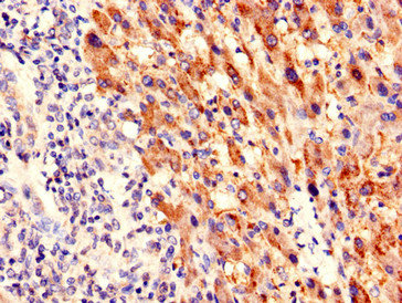 PIM3 / PIM-3 Antibody - Immunohistochemistry of paraffin-embedded human liver cancer using PIM3 Antibody at dilution of 1:100