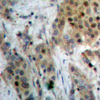 PIN1 Antibody - Immunohistochemical analysis of PIN1 staining in human prostate cancer formalin fixed paraffin embedded tissue section. The section was pre-treated using heat mediated antigen retrieval with sodium citrate buffer (pH 6.0). The section was then incubated with the antibody at room temperature and detected using an HRP conjugated compact polymer system. DAB was used as the chromogen. The section was then counterstained with hematoxylin and mounted with DPX.