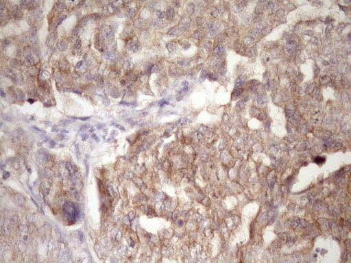 PIN4 Antibody - Immunohistochemical staining of paraffin-embedded Adenocarcinoma of Human ovary tissue using anti-PIN4 mouse monoclonal antibody. (Heat-induced epitope retrieval by Tris-EDTA, pH8.0)(1:150)