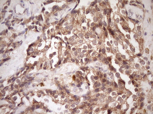 PIN4 Antibody - Immunohistochemical staining of paraffin-embedded Adenocarcinoma of Human breast tissue using anti-PIN4 mouse monoclonal antibody. (Heat-induced epitope retrieval by Tris-EDTA, pH8.0)(1:150)