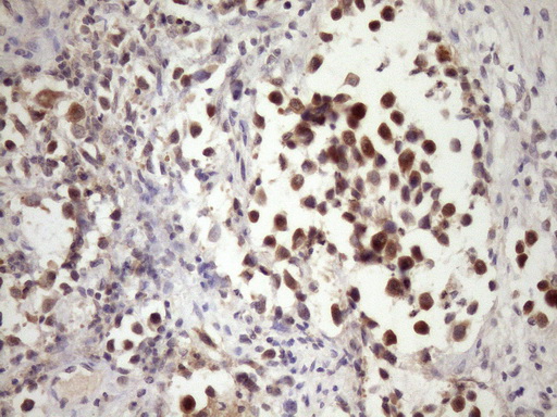 PIN4 Antibody - Immunohistochemical staining of paraffin-embedded Human bladder tissue within the normal limits using anti-PIN4 mouse monoclonal antibody. (Heat-induced epitope retrieval by Tris-EDTA, pH8.0)(1:150)