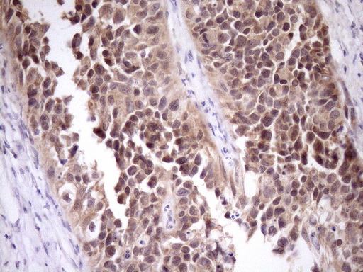 PIN4 Antibody - Immunohistochemical staining of paraffin-embedded Carcinoma of Human kidney tissue using anti-PIN4 mouse monoclonal antibody. (Heat-induced epitope retrieval by Tris-EDTA, pH8.0)(1:150)