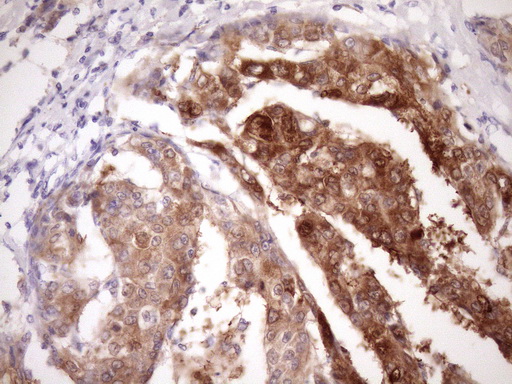 PIN4 Antibody - Immunohistochemical staining of paraffin-embedded Carcinoma of Human liver tissue using anti-PIN4 mouse monoclonal antibody. (Heat-induced epitope retrieval by Tris-EDTA, pH8.0)(1:150)