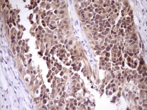 PIN4 Antibody - IHC of paraffin-embedded Carcinoma of Human kidney tissue using anti-PIN4 mouse monoclonal antibody. (Heat-induced epitope retrieval by Tris-EDTA, pH8.0)(1:150).