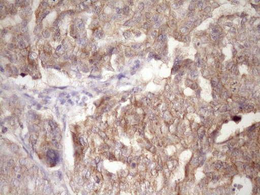 PIN4 Antibody - IHC of paraffin-embedded Adenocarcinoma of Human ovary tissue using anti-PIN4 mouse monoclonal antibody. (Heat-induced epitope retrieval by Tris-EDTA, pH8.0)(1:150).