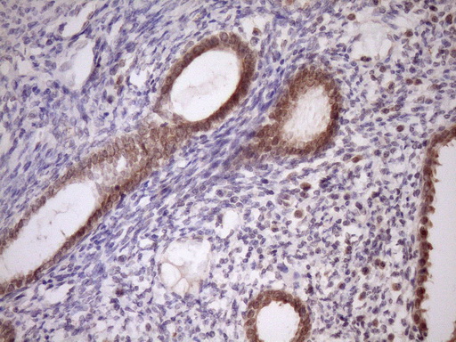 PIN4 Antibody - IHC of paraffin-embedded Carcinoma of Human pancreas tissue using anti-PIN4 mouse monoclonal antibody. (Heat-induced epitope retrieval by Tris-EDTA, pH8.0)(1:150).