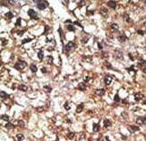 PINK1 Antibody - Formalin-fixed and paraffin-embedded human cancer tissue reacted with the primary antibody, which was peroxidase-conjugated to the secondary antibody, followed by AEC staining. This data demonstrates the use of this antibody for immunohistochemistry; clinical relevance has not been evaluated. BC = breast carcinoma; HC = hepatocarcinoma.