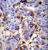 PIP / GCDFP-15 Antibody - GCDFP-15 Antibody immunohistochemistry of formalin-fixed and paraffin-embedded human breast carcinoma followed by peroxidase-conjugated secondary antibody and DAB staining.