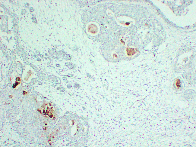 PIP / GCDFP-15 Antibody - Breast Carcinoma