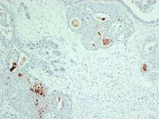 PIP / GCDFP-15 Antibody - Breast Carcinoma