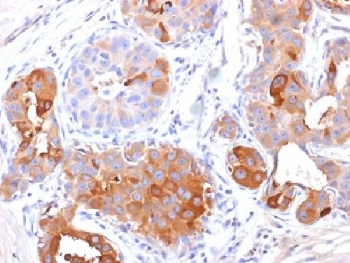 PIP / GCDFP-15 Antibody - IHC testing of FFPE human breast carcinoma with PIP antibody (clone PIP/1571). Required HIER: boil tissue sections in 10mM Tris with 1mM EDTA, pH 9, for 10-20.