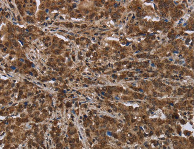PIP / GCDFP-15 Antibody - Immunohistochemistry of paraffin-embedded Human liver cancer using PIP Polyclonal Antibody at dilution of 1:50.