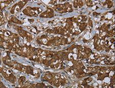 PIP / GCDFP-15 Antibody - Immunohistochemistry of paraffin-embedded Human cervical cancer using PIP Polyclonal Antibody at dilution of 1:50.