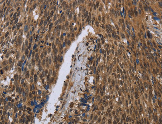 PIP / GCDFP-15 Antibody - Immunohistochemistry of paraffin-embedded Human cervical cancer using PIP Polyclonal Antibody at dilution of 1:50.