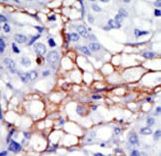 PIP4K2A / PIPK Antibody - Formalin-fixed and paraffin-embedded human cancer tissue reacted with the primary antibody, which was peroxidase-conjugated to the secondary antibody, followed by DAB staining. This data demonstrates the use of this antibody for immunohistochemistry; clinical relevance has not been evaluated. BC = breast carcinoma; HC = hepatocarcinoma.