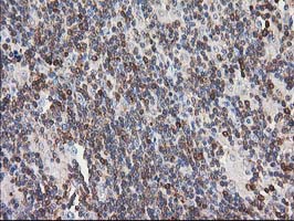 PIP4K2A / PIPK Antibody - IHC of paraffin-embedded Human lymphoma tissue using anti-PIP4K2A mouse monoclonal antibody.