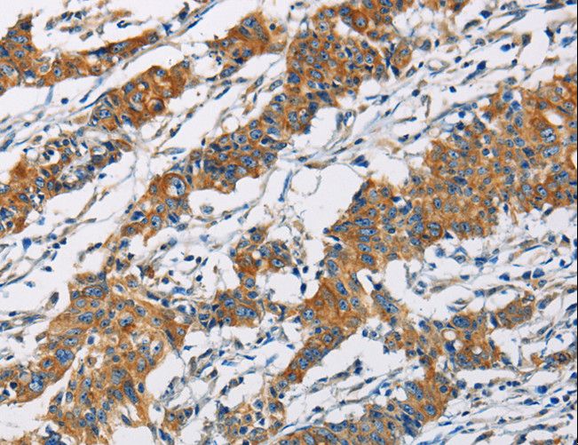 PIP4K2A / PIPK Antibody - Immunohistochemistry of paraffin-embedded Human gastric cancer using PIP4K2A Polyclonal Antibody at dilution of 1:40.
