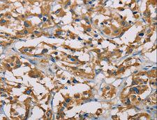 PIP4K2A / PIPK Antibody - Immunohistochemistry of paraffin-embedded Human thyroid cancer using PIP4K2A Polyclonal Antibody at dilution of 1:50.