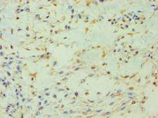 PIP4K2B Antibody - Immunohistochemistry of paraffin-embedded human breast cancer using antibody at 1:100 dilution.